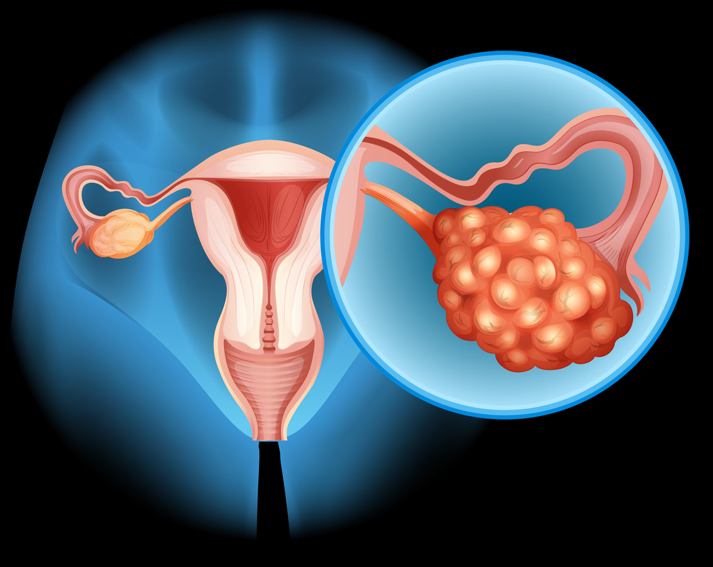 Рак яичников чаще всего поражает женщин в постменопаузе
