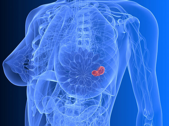 Лечение рака груди при беременности
