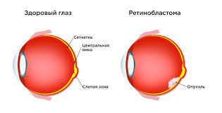 Ретинобластома - самый распространенный рак глаза у детей.