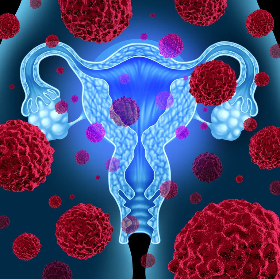 Рак эндометрия (рак матки)